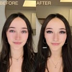 before y affer 1